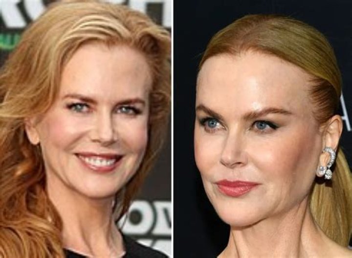 Did Nicole Kidman Get A Facelift: Uncovering The Truth
