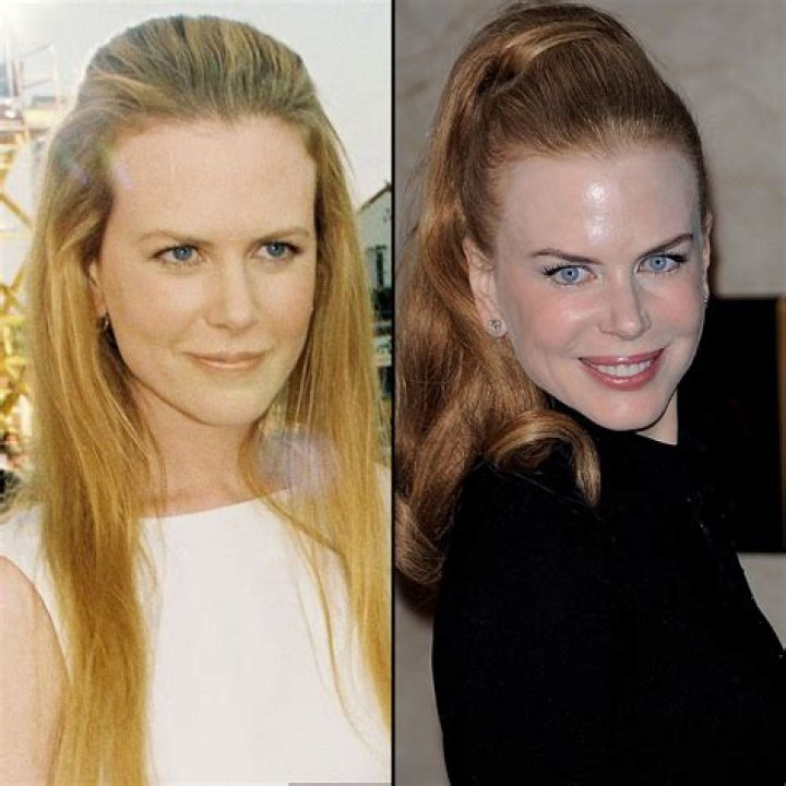 The Truth About Nicole Kidman's Nose Job: Before And After Transformation