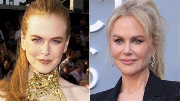 Unveiling The Secrets Of Nicole Kidman's Plastic Surgery Journey